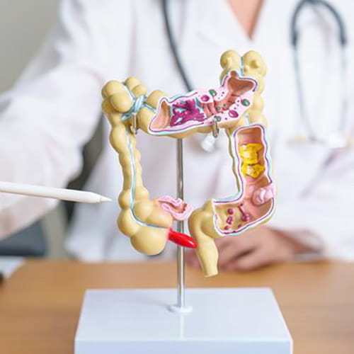 A doctor in a white coat pointing to an anatomical model of the large intestine (colon), showing cross-sections with various colorectal conditions such as polyps, inflammation, and hemorrhoids.